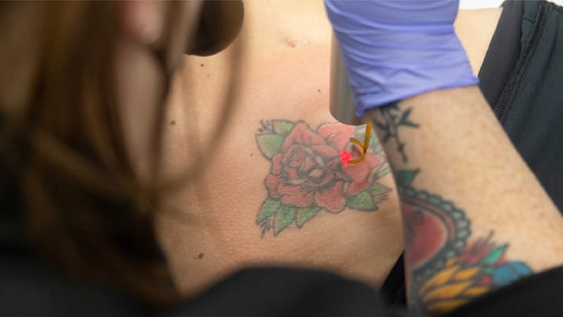 Removery Tattoo Removal & Fading
