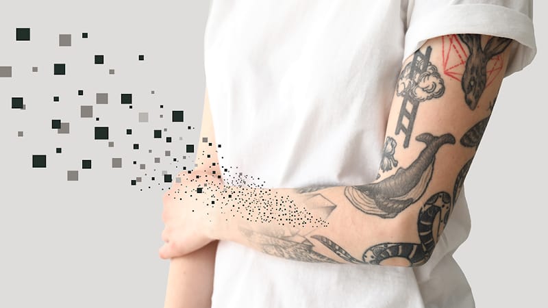 Removery Tattoo Removal & Fading